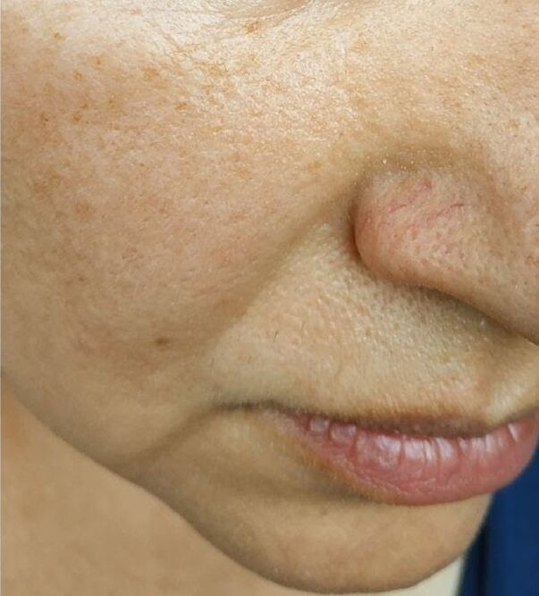 By the age of 40, nasolabial wrinkles appeared