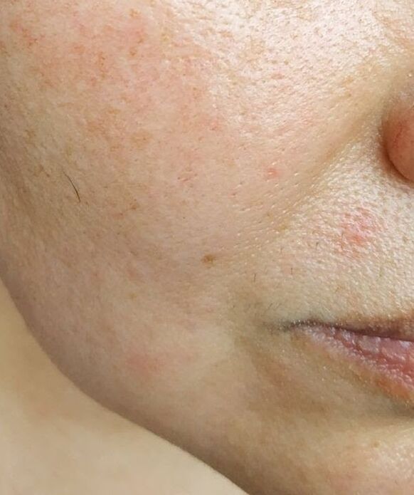 Intenskin gets rid of deep nasolabial folds